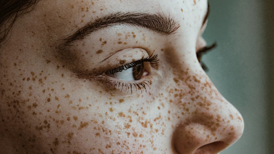 WHAT ARE FRECKLES? SUMMARY OF EFFECTIVE WAYS TO TREAT FRECKLES