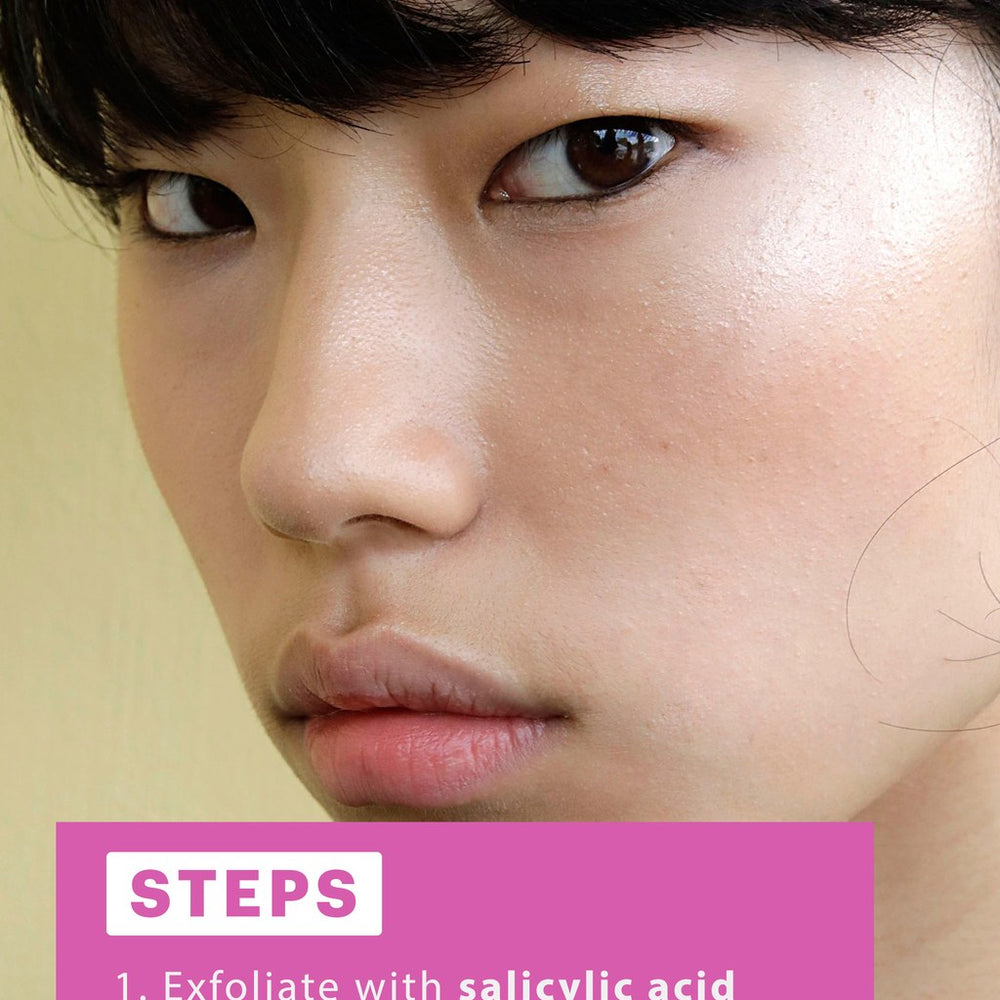 4 Steps to Getting Rid of a Cystic Pimple, Fast