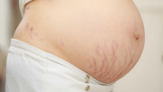 How to treat stretch marks after giving birth safely and effectively for women?